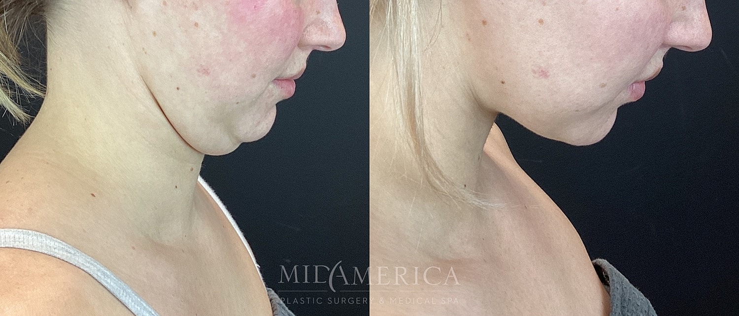 Before and after chin contouring treatment comparison.