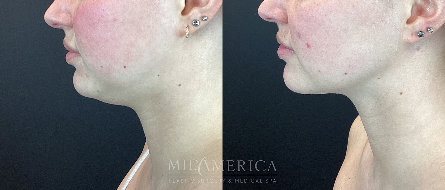 Before and after profile view of chin transformation.