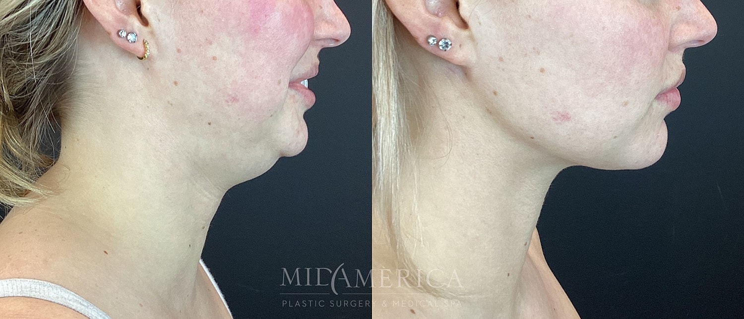 Before and after cosmetic jawline enhancement.