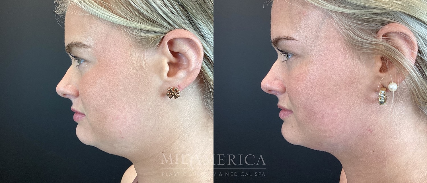 Before and after side profile comparison of woman