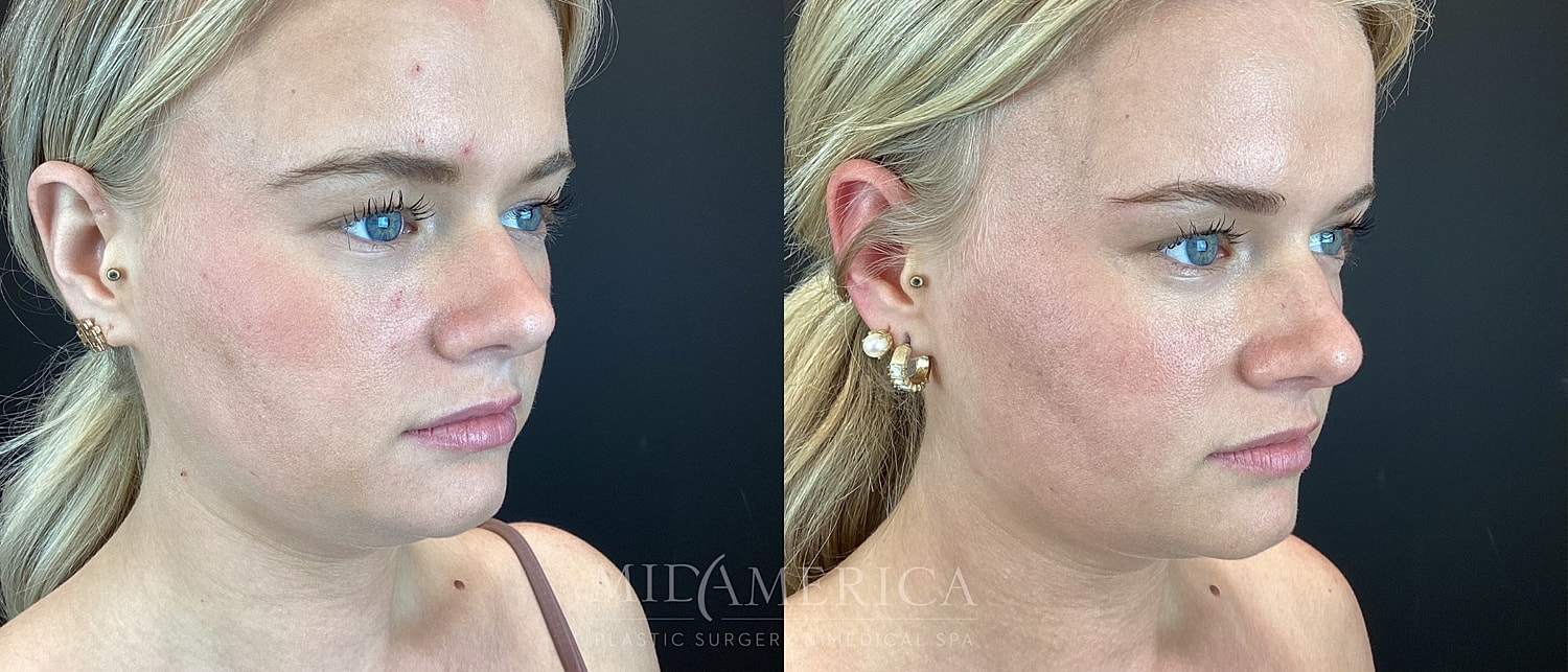 Profile comparison of skin treatment results.