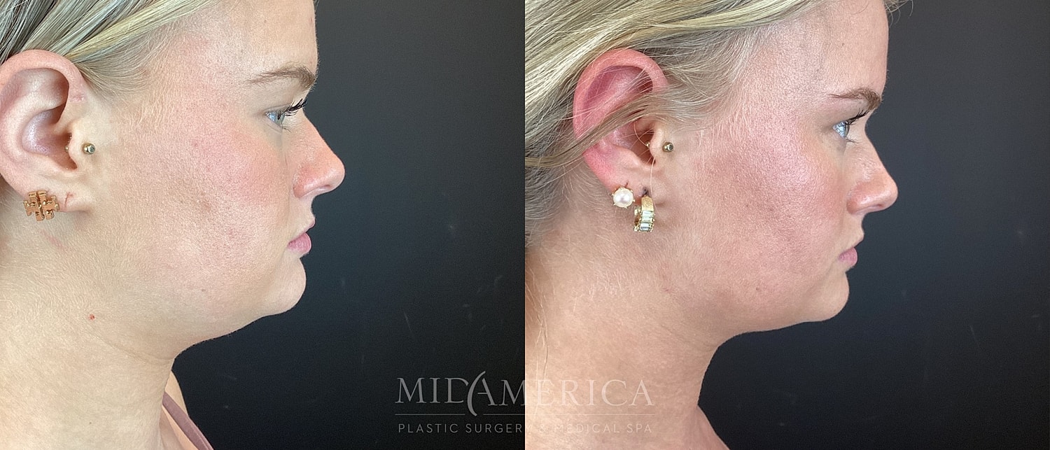 Before and after profile comparison of ear piercings.