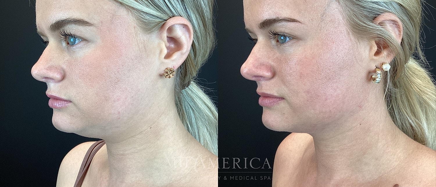 Before and after facial contouring comparison.
