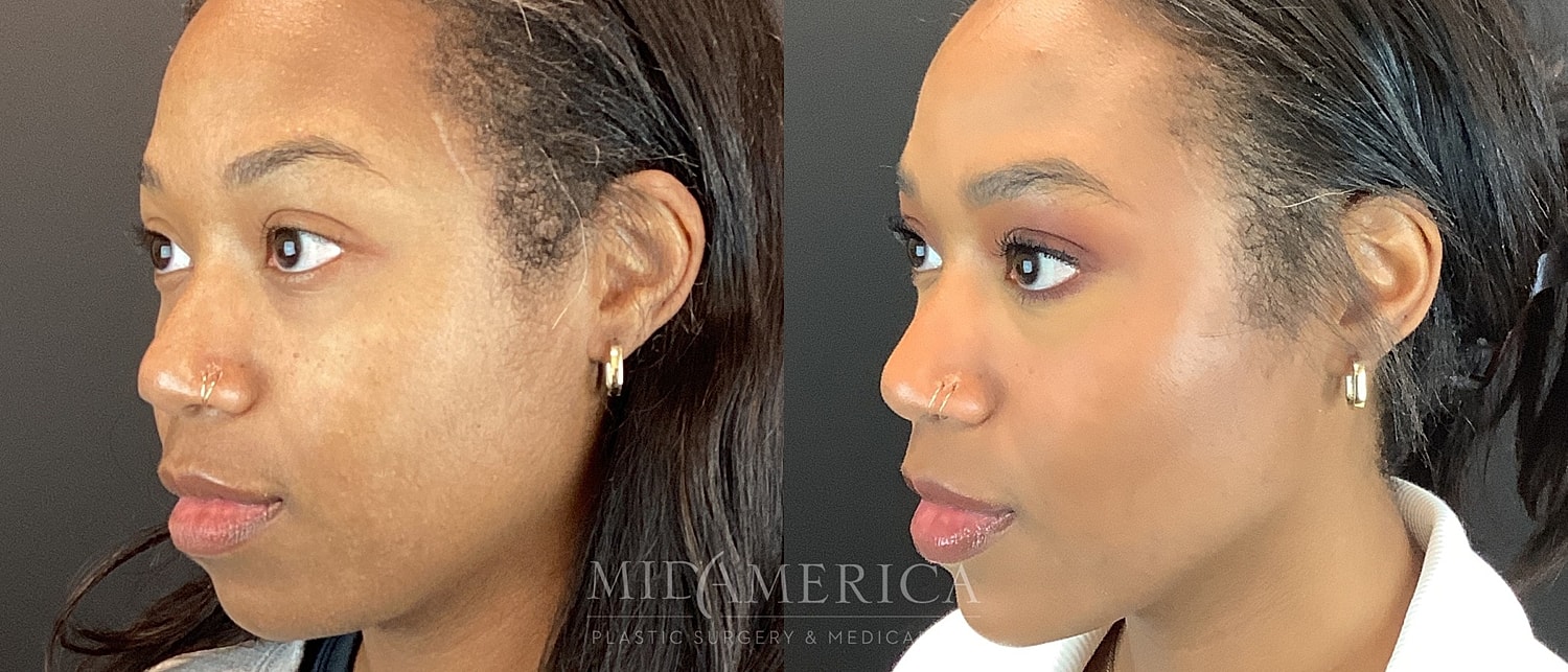 Cheek Filler Before & After