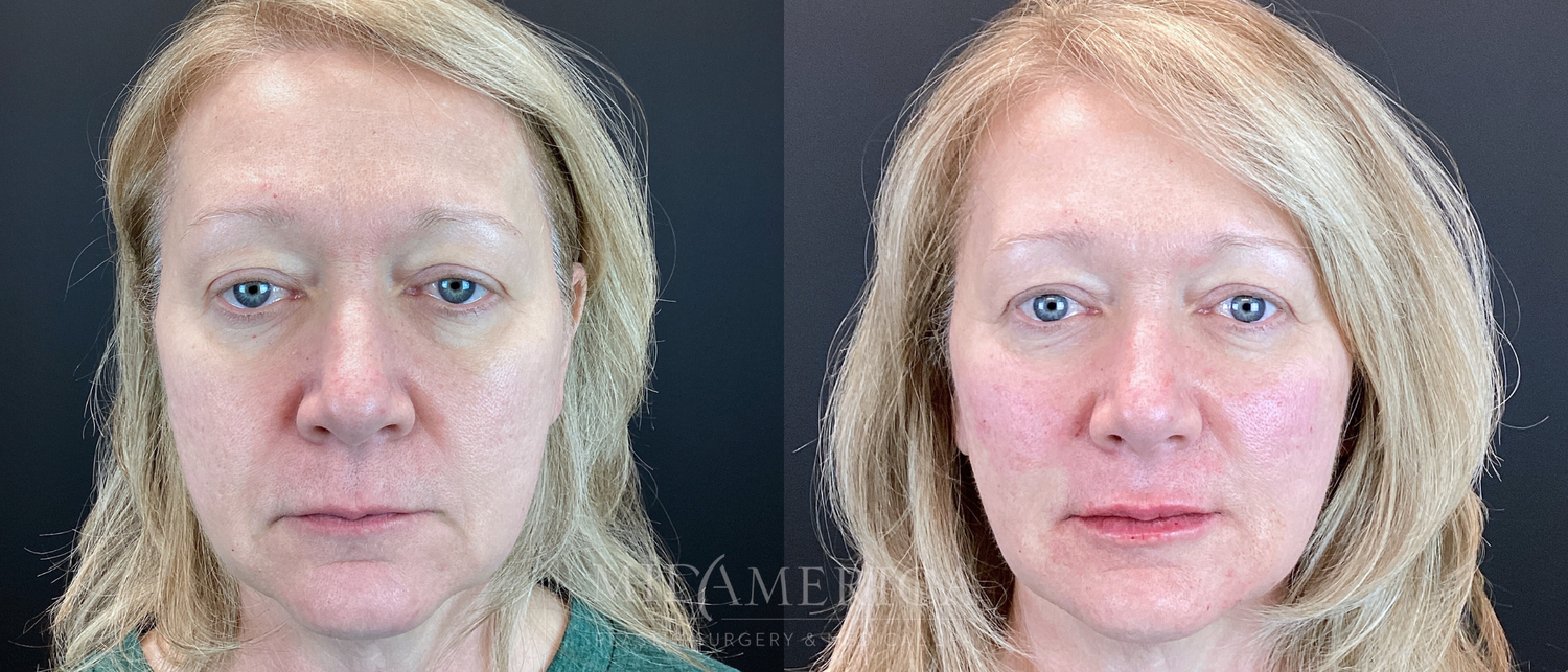 Cheek Filler Before & After