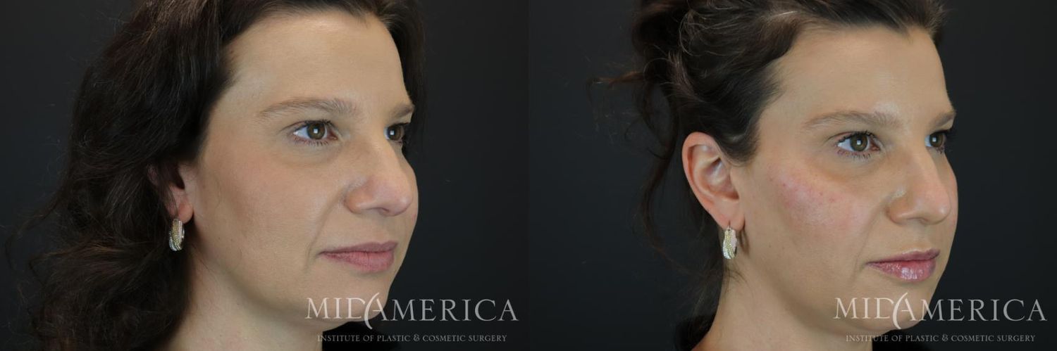Cheek Filler Before & After