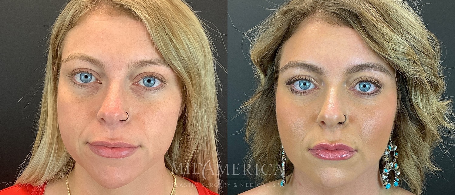 Cheek Filler Before & After
