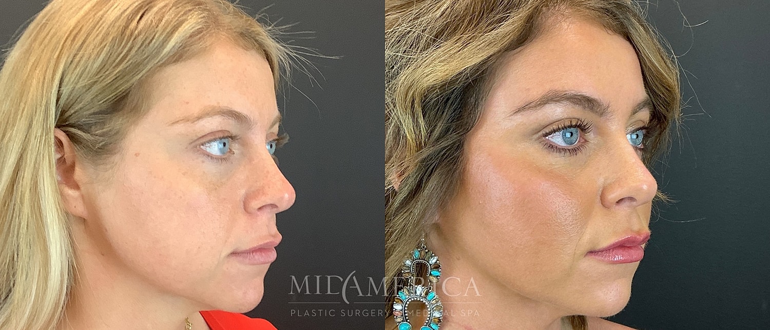 Cheek Filler Before & After
