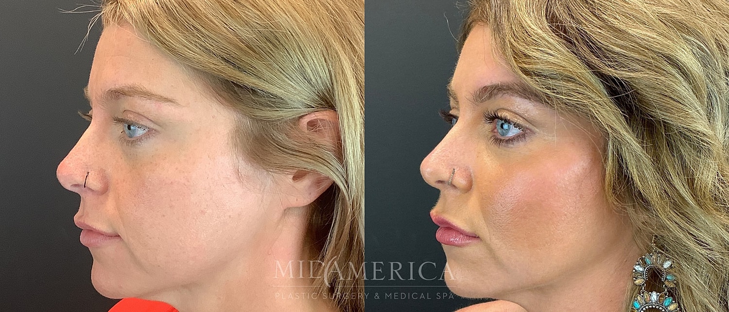 Cheek Filler Before & After