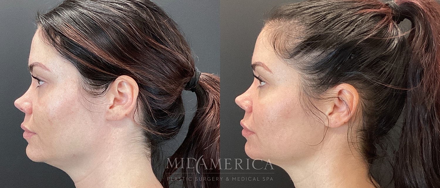 Cheek Filler Before & After