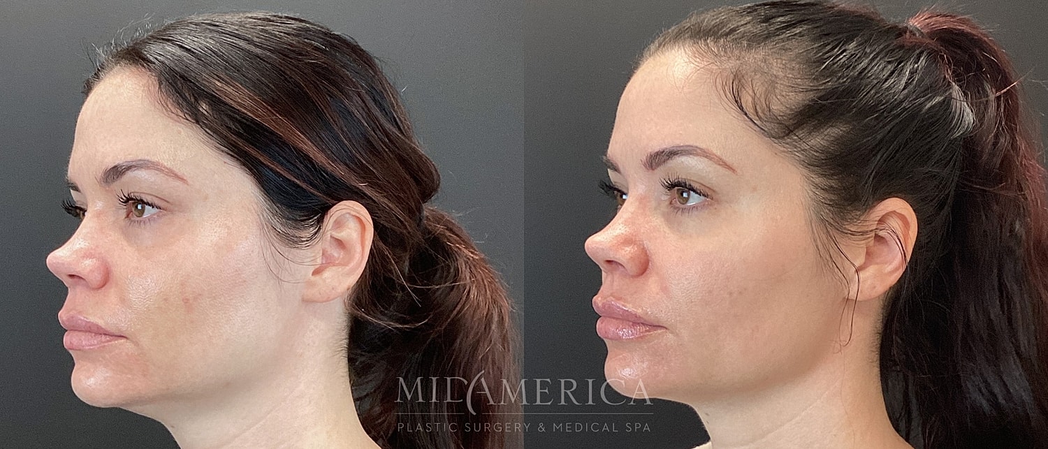 Cheek Filler Before & After