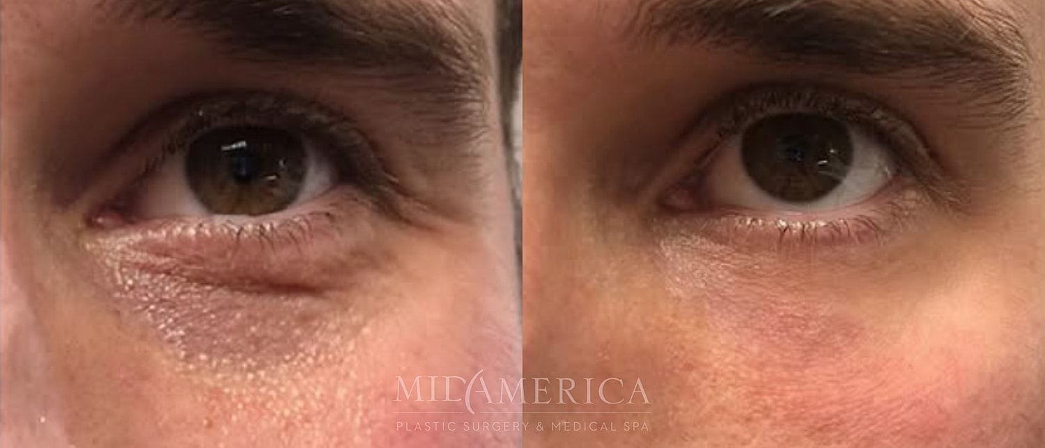 Before and after eye treatment comparison.