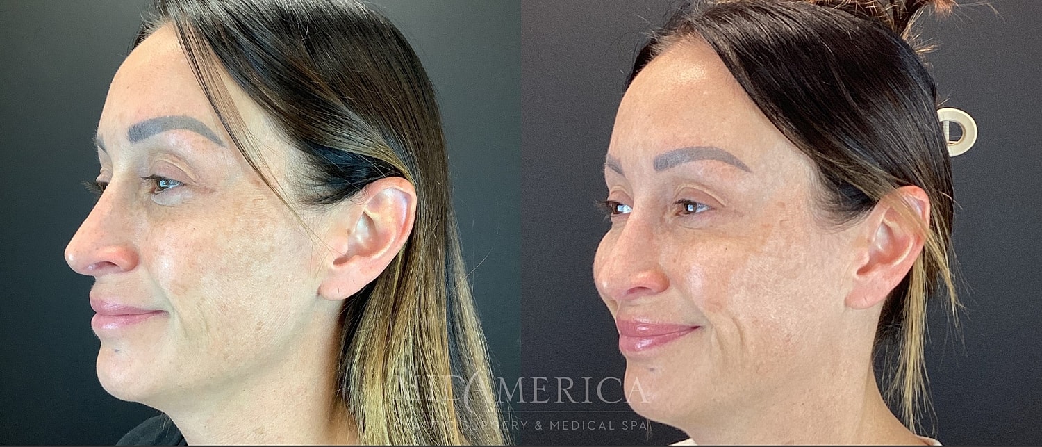 Cheek Filler Before & After