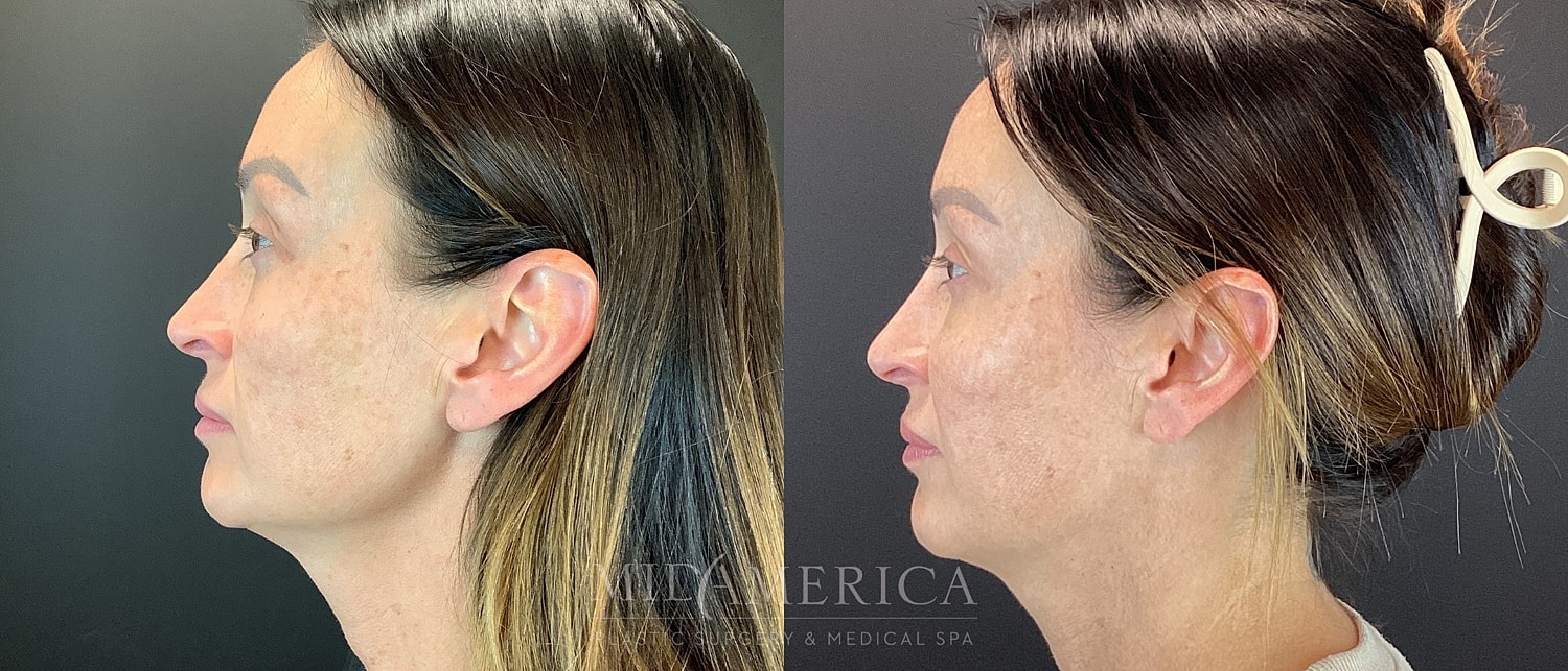 Cheek Filler Before & After