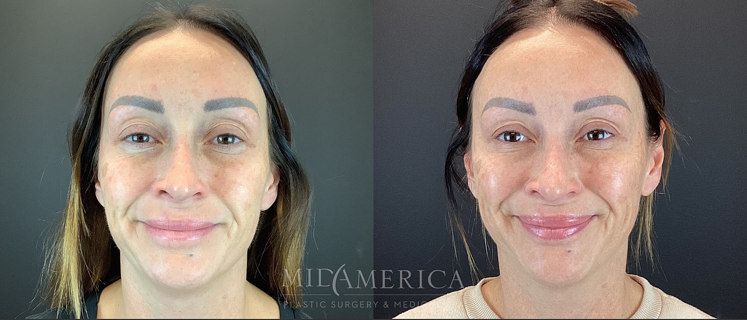 Cheek Filler Before & After