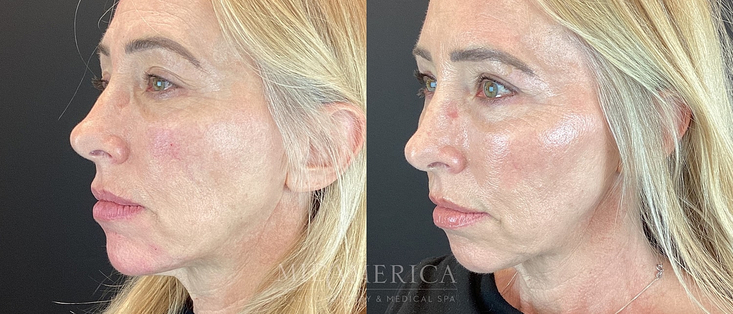 Cheek Filler Before & After