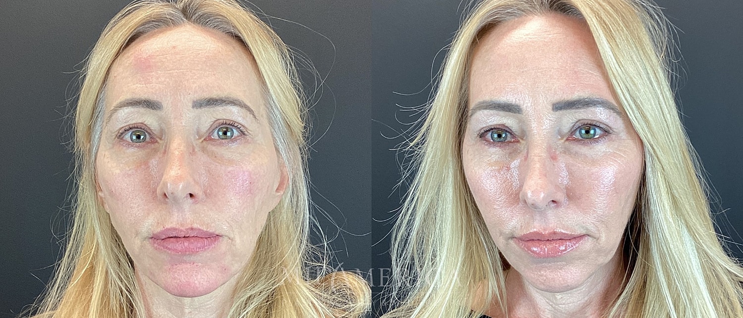 Cheek Filler Before & After