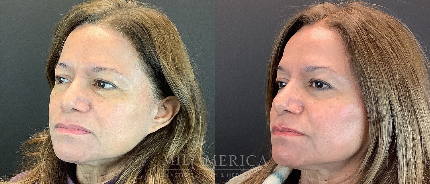 Before and after facial treatment comparison photo.