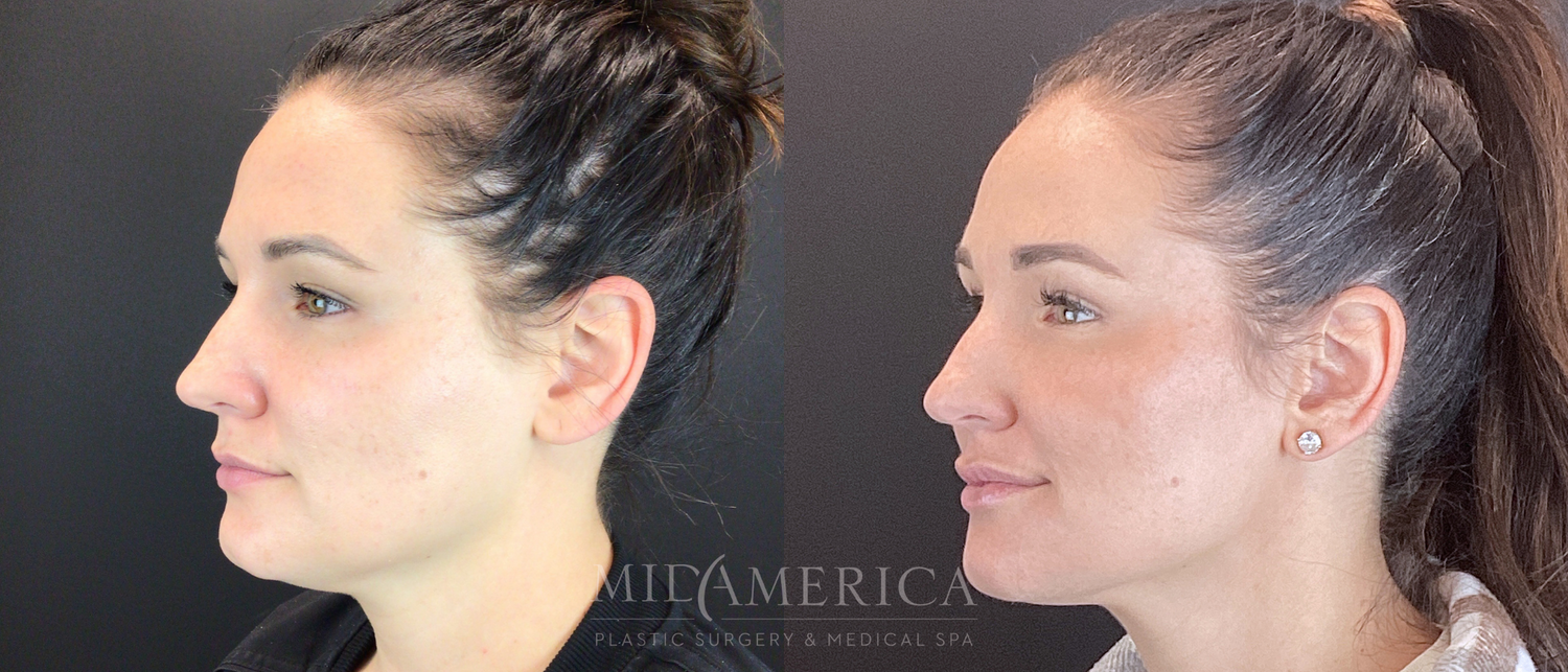 Cheek Filler Before & After