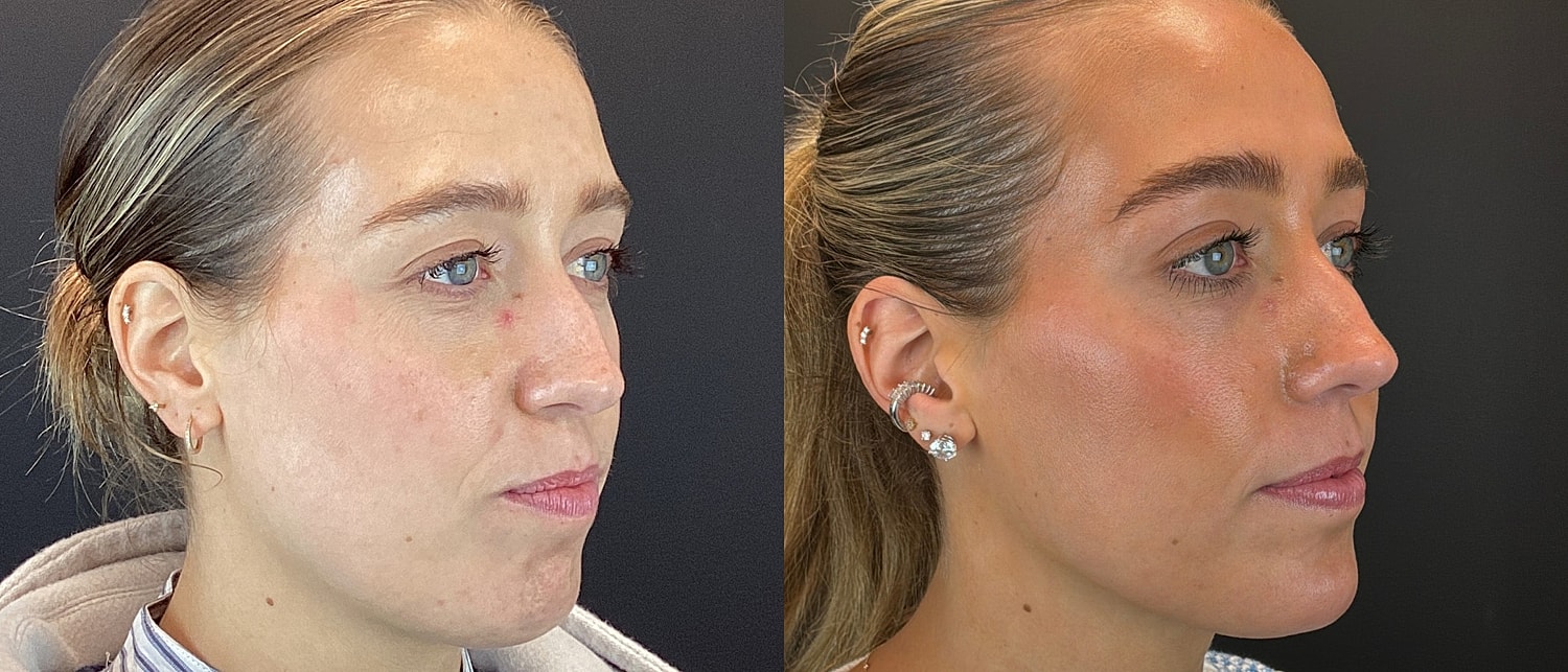 Cheek Filler Before & After