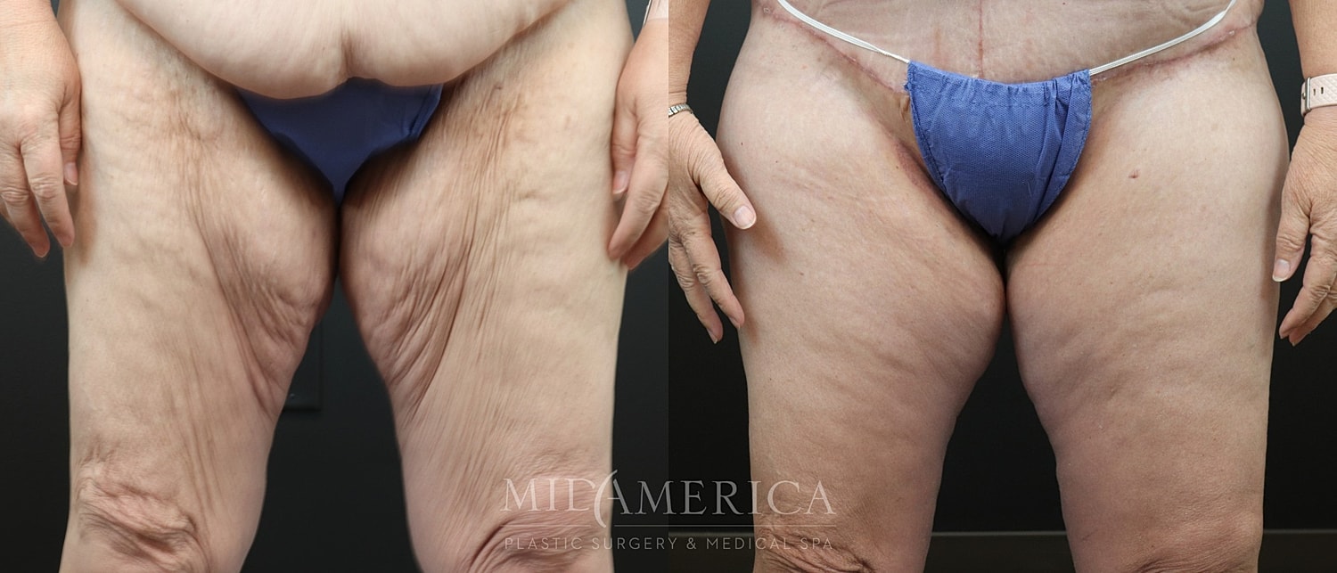 Thigh Lift Before & After