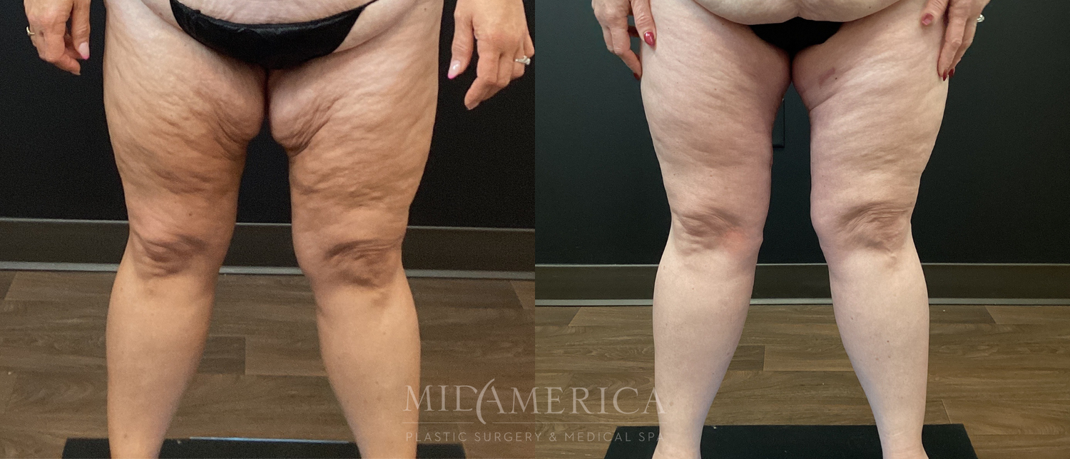 Thigh Lift Before & After