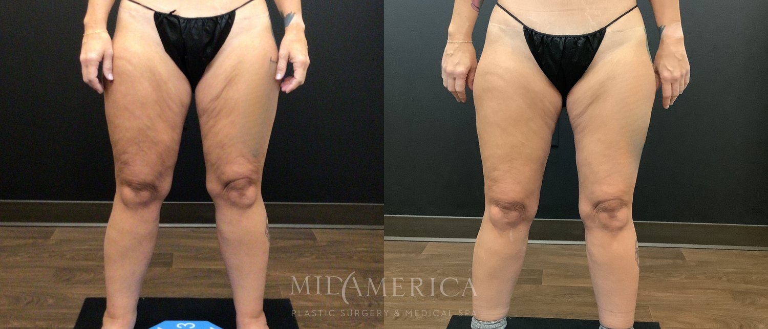 Thigh Lift Before & After