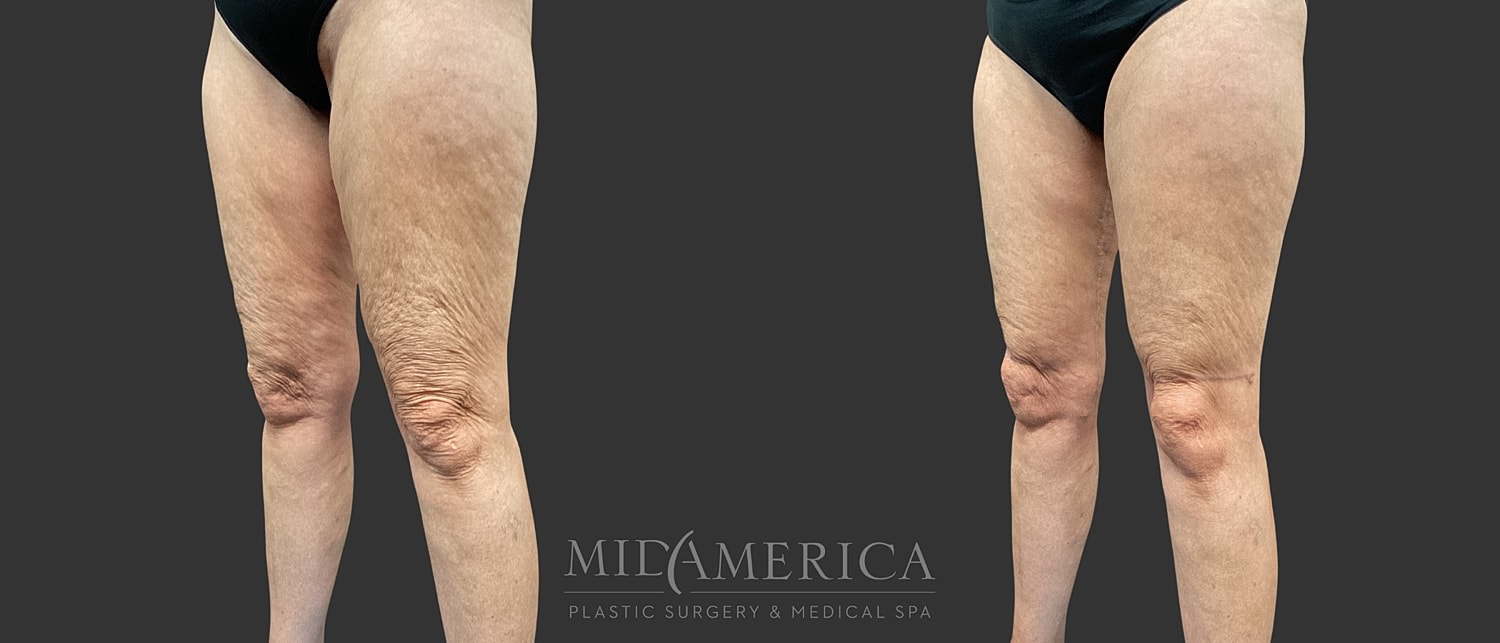 Thigh Lift Before & After