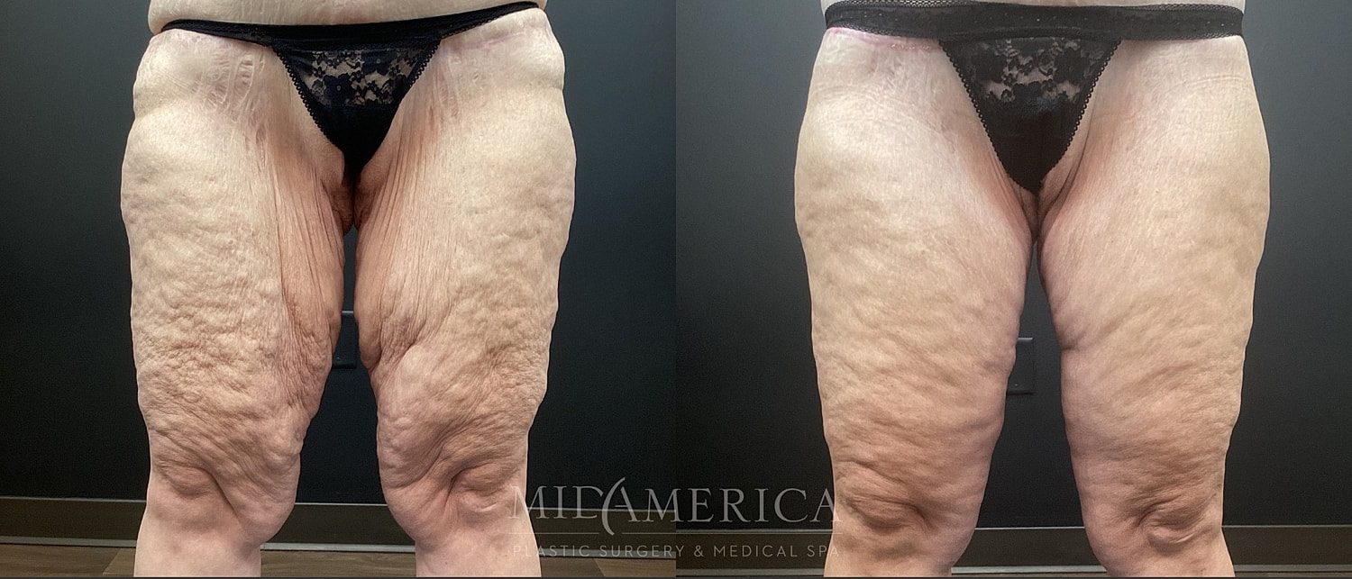 Thigh Lift Before & After