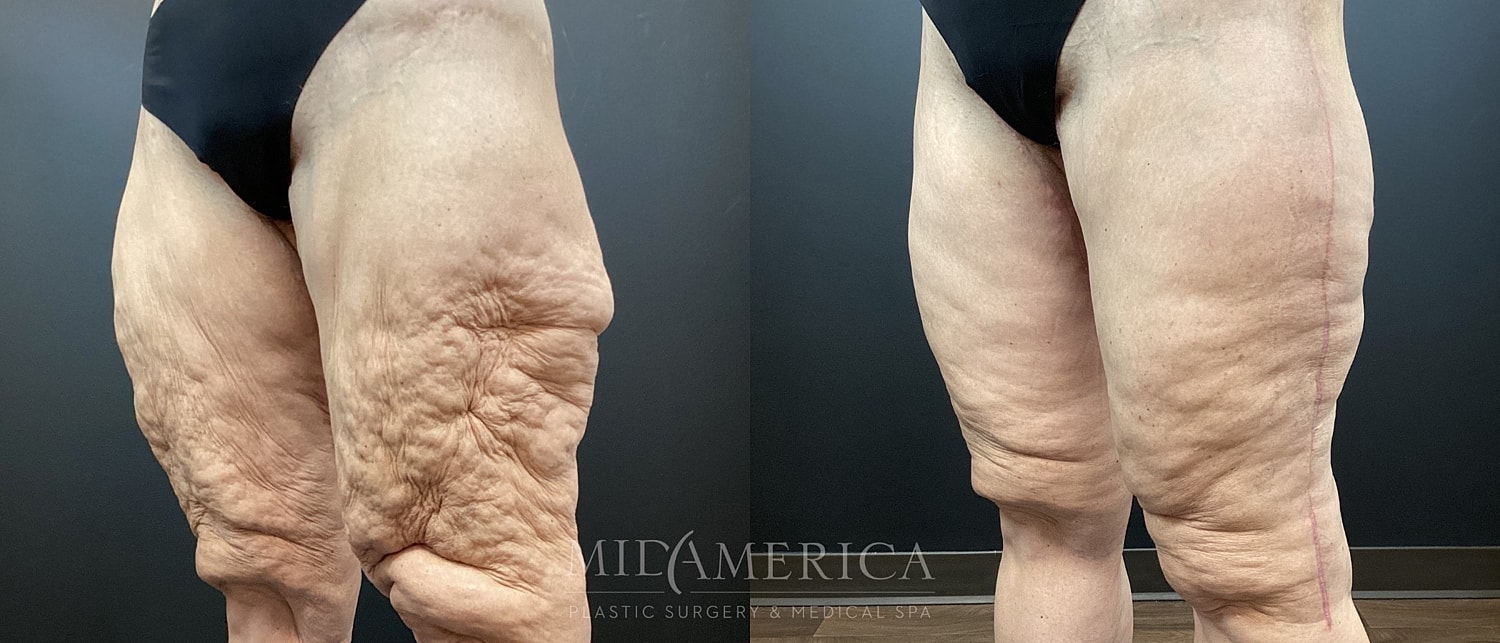 Before and after leg skin treatment images.