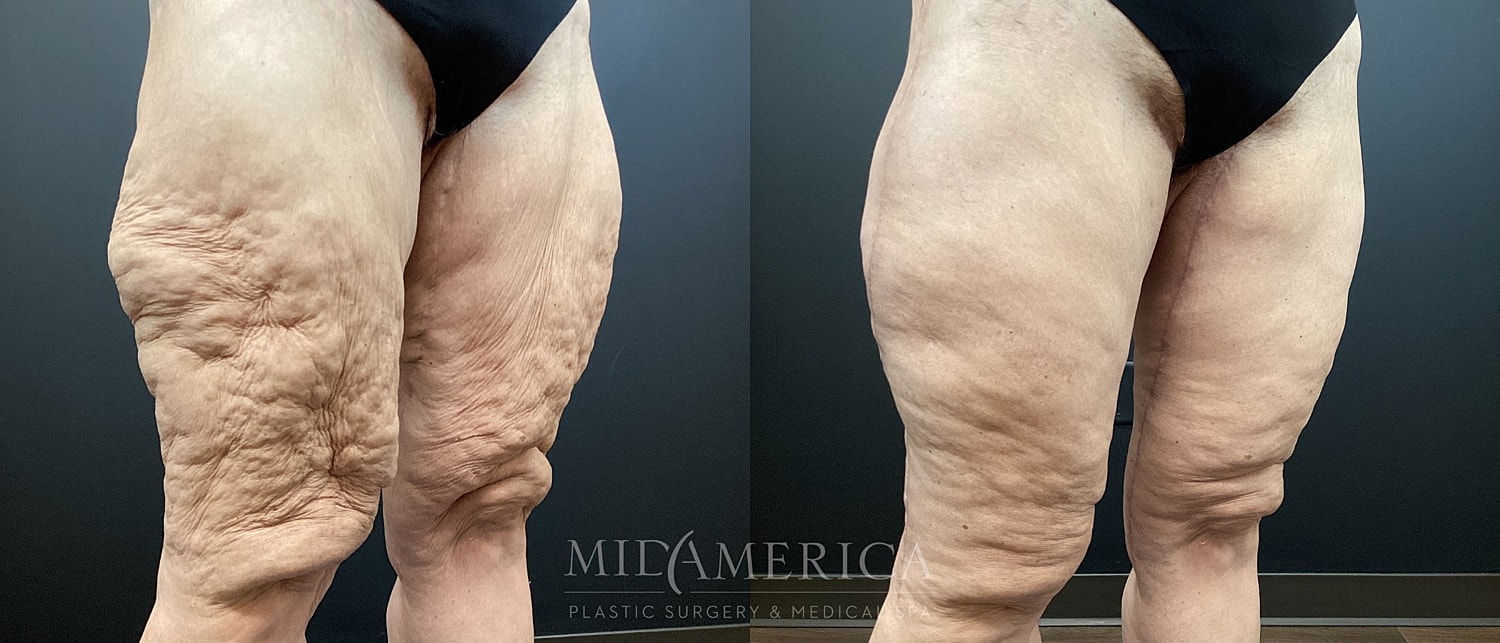 Before and after leg treatment comparison.