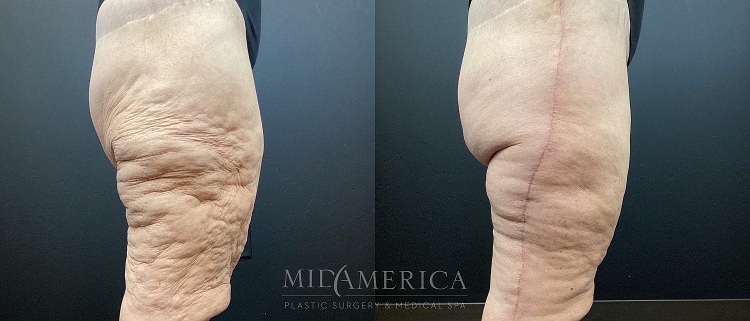 Before and after leg cosmetic procedure comparison.