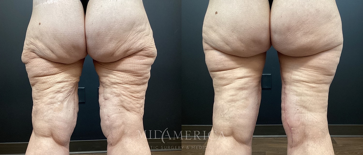 Before and after buttock appearance comparison