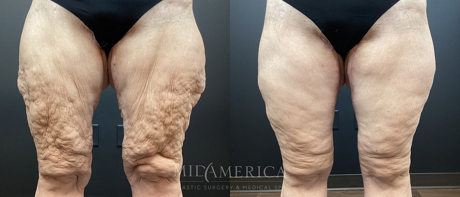 Before and after thigh skin treatment comparison.