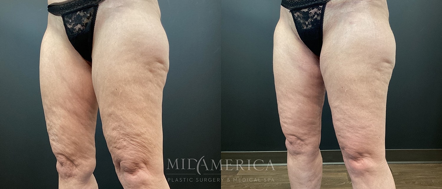 Before and after leg cellulite treatment comparison.