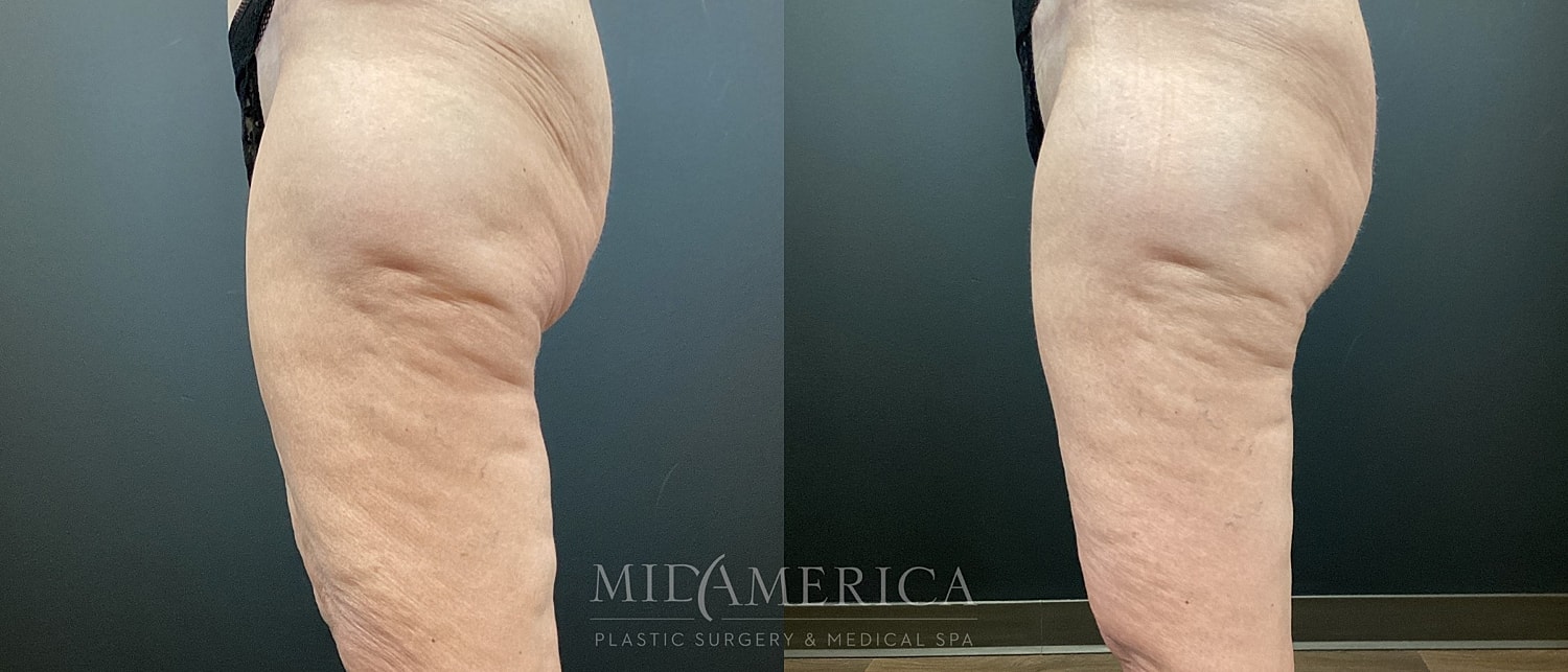 Before and after arm skin treatment comparison.