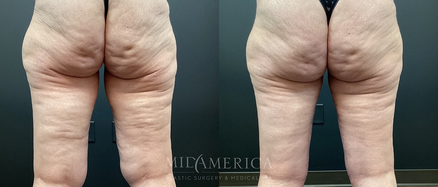 Thigh Lift Before & After