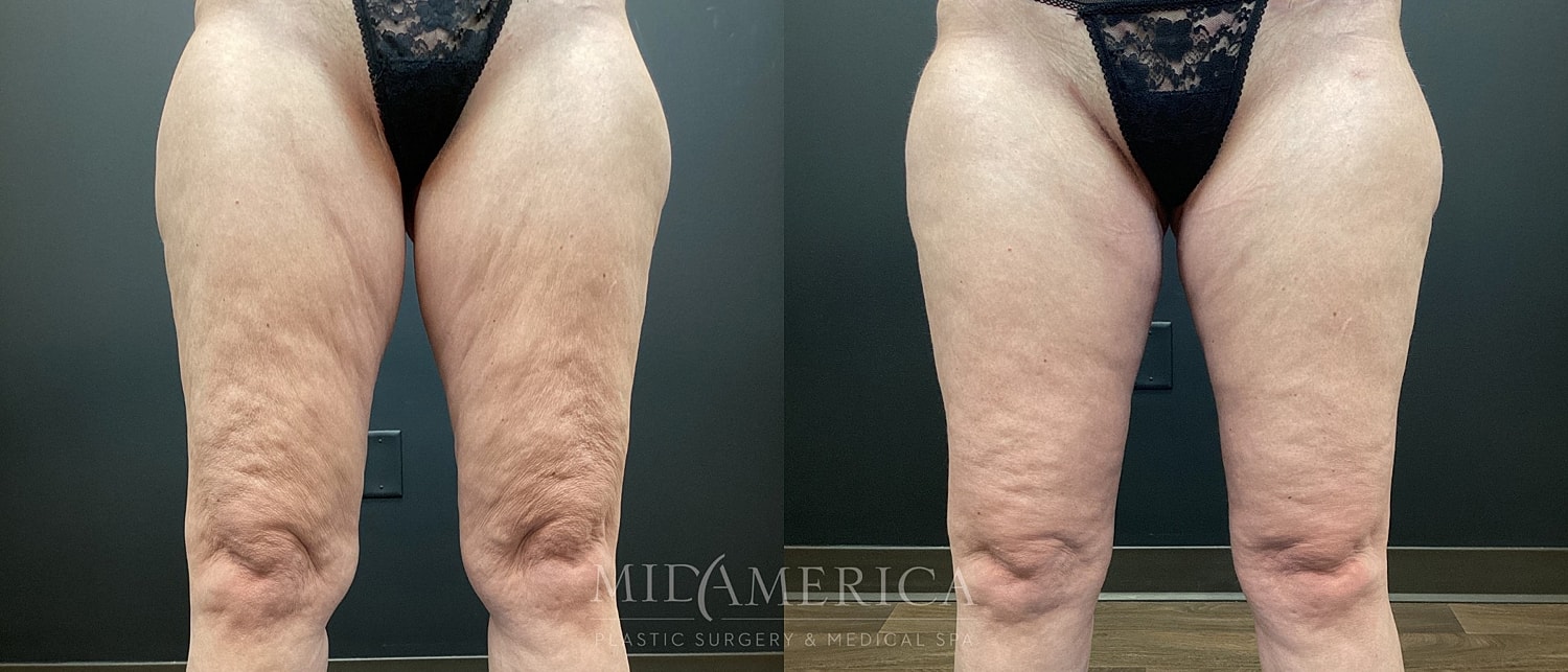 Before and after leg treatment comparison.