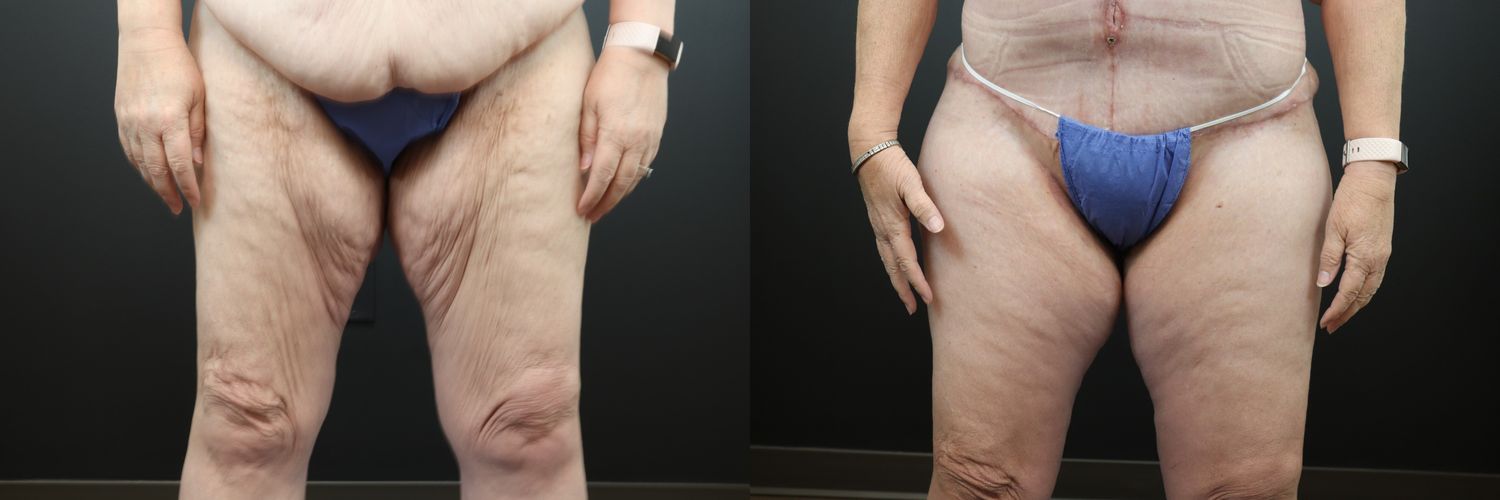 Thigh Lift Before & After