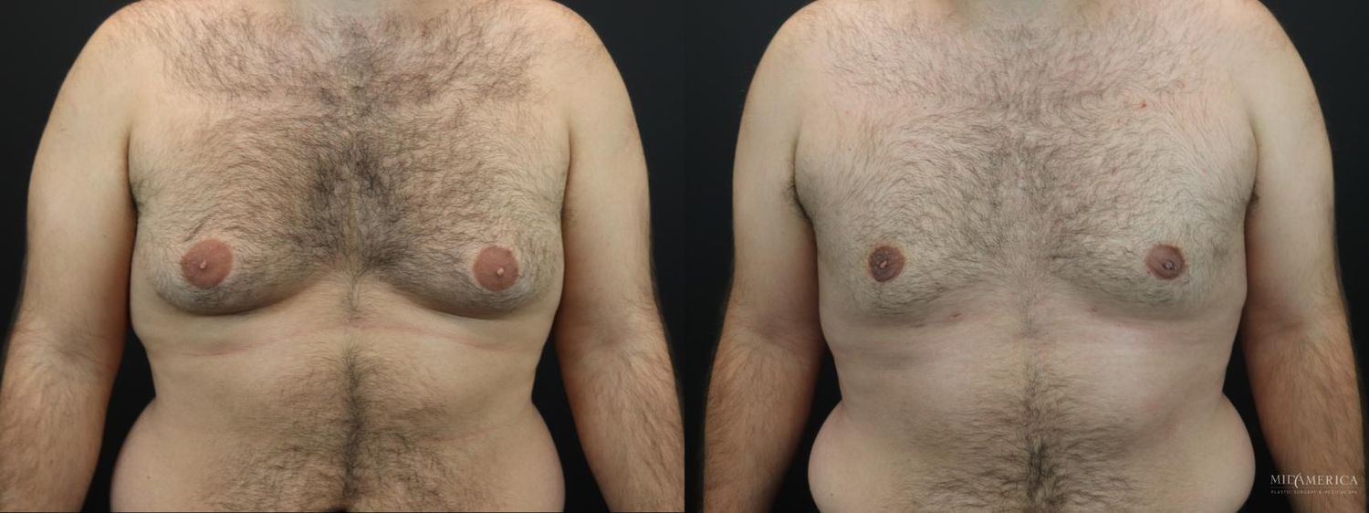 Gynecomastia Before & After