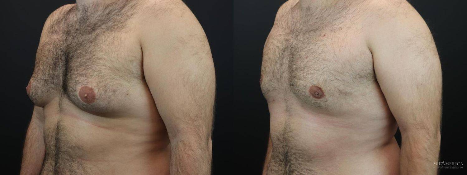 Gynecomastia Before & After
