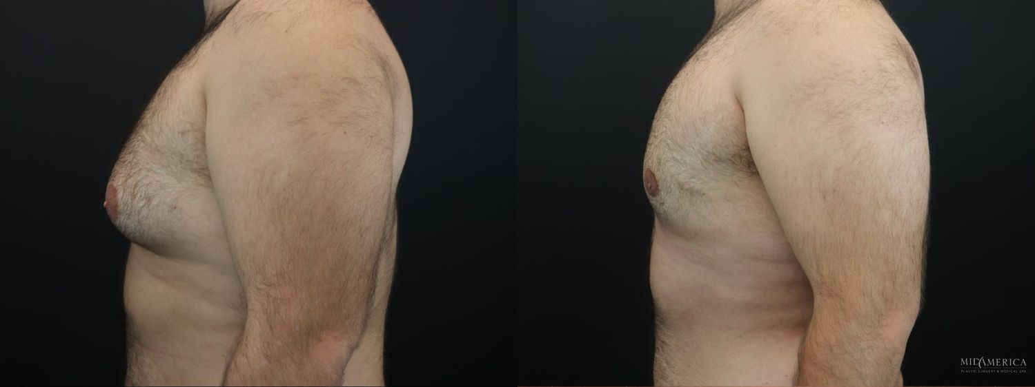 Gynecomastia Before & After