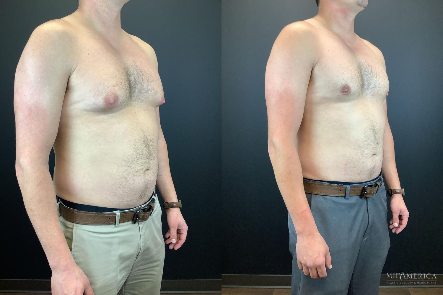 Gynecomastia Before & After