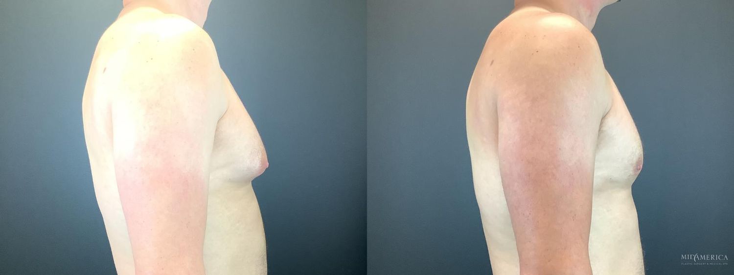 Gynecomastia Before & After