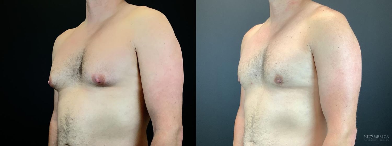 Gynecomastia Before & After