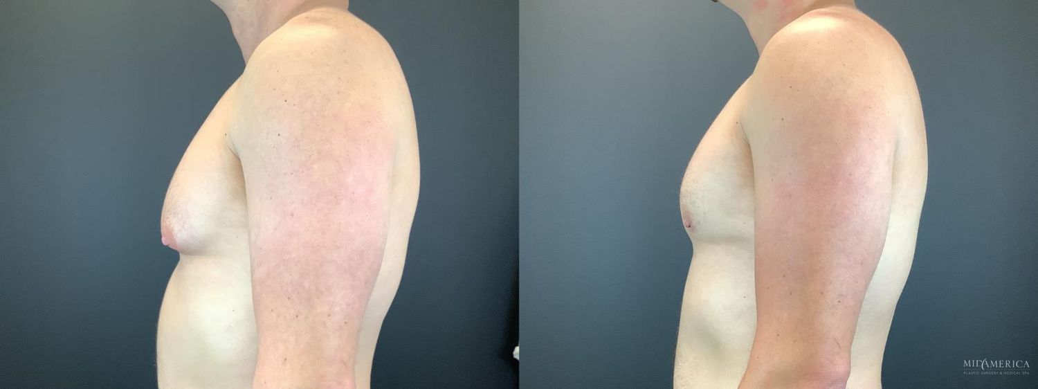 Gynecomastia Before & After