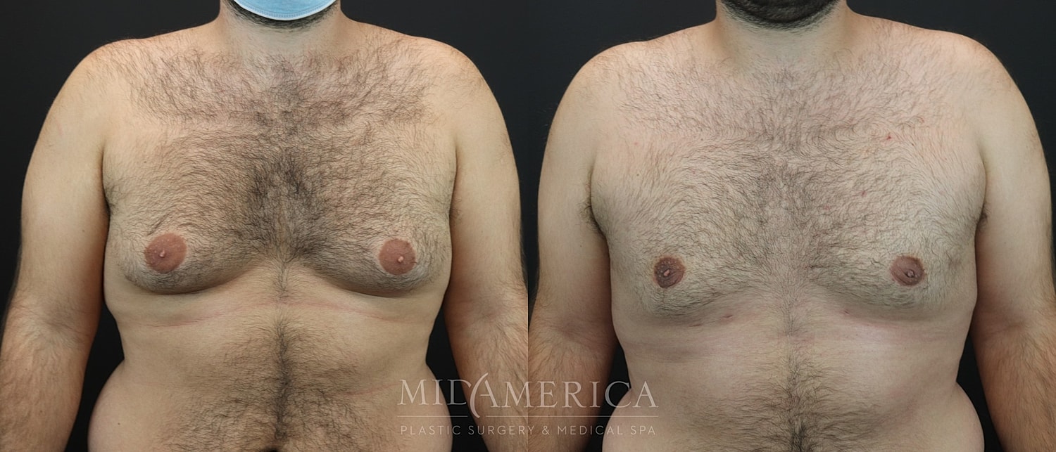 Gynecomastia Before & After