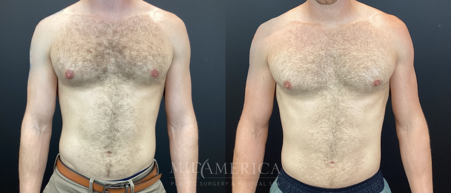 Gynecomastia Before & After