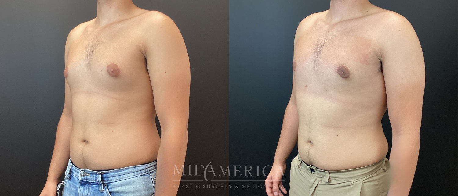 Gynecomastia Before & After