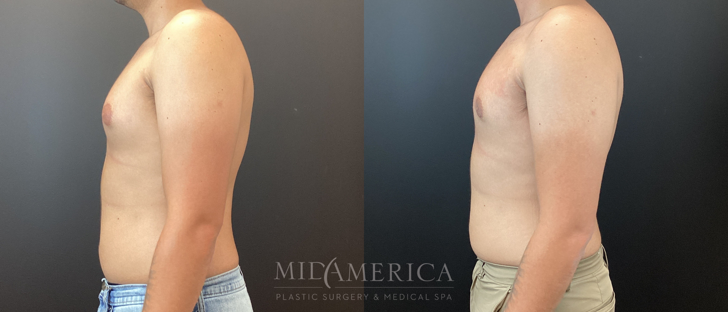 Gynecomastia Before & After